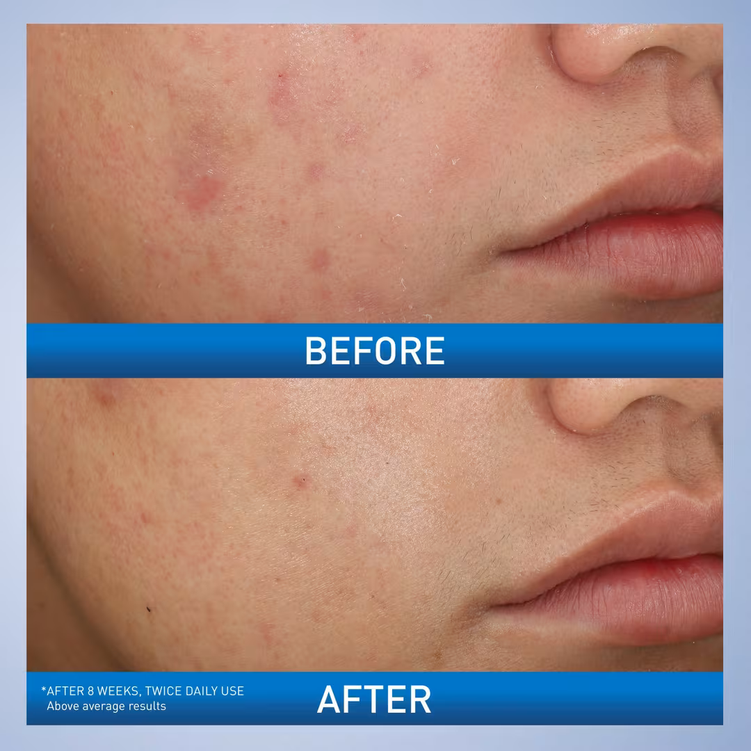 Acne Foaming Cream Wash Before After