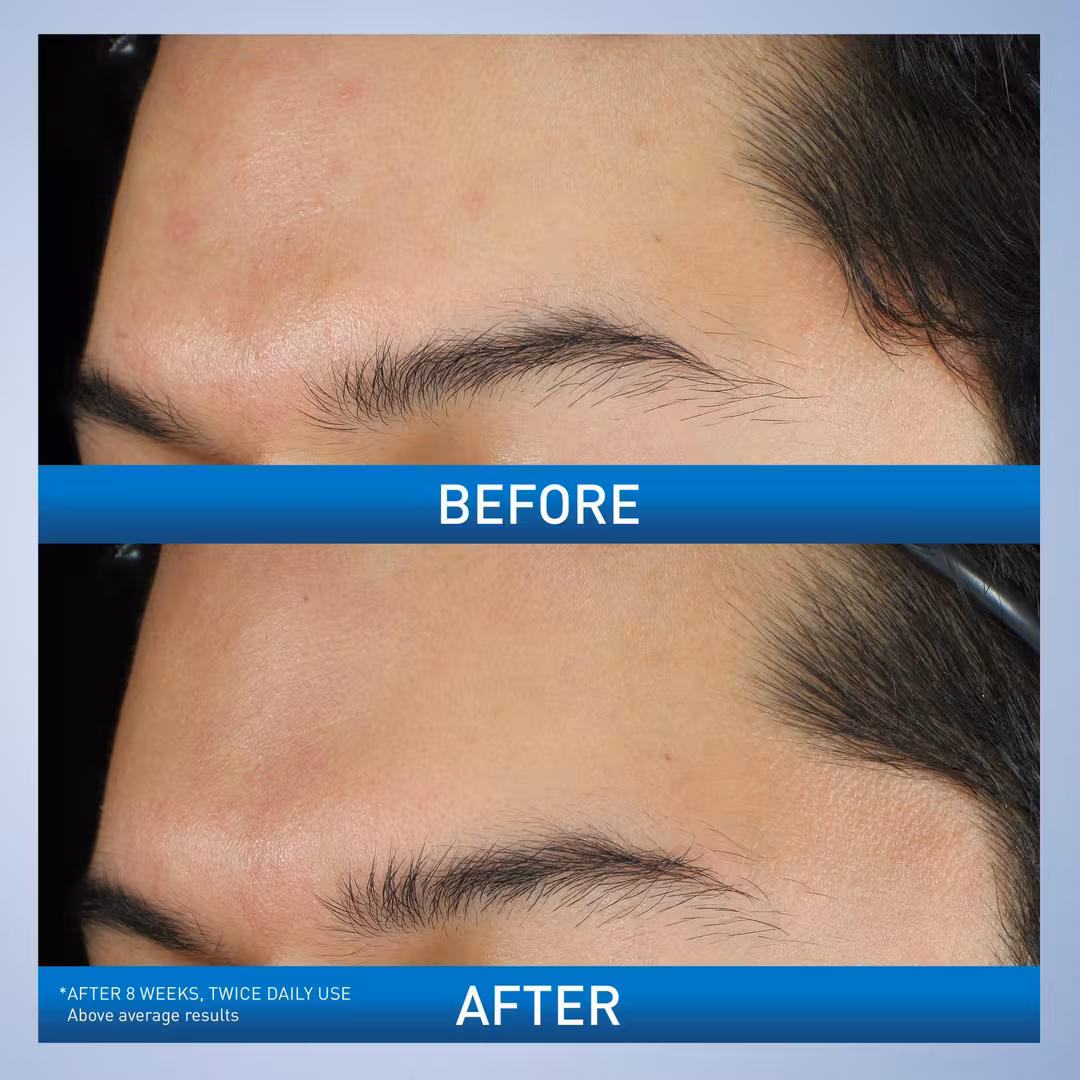 Acne Foaming Cream Wash Before After