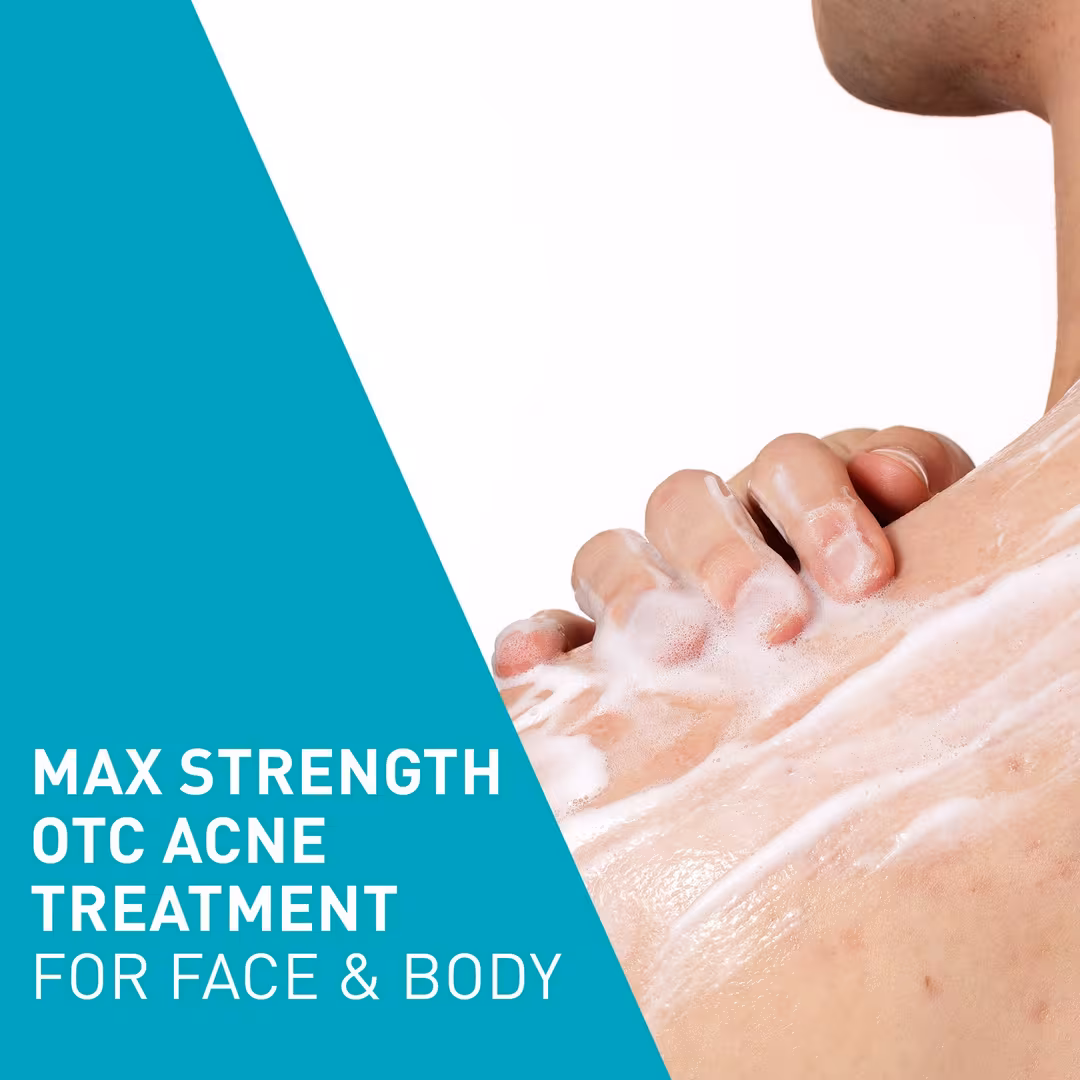Acne Foaming Cream
